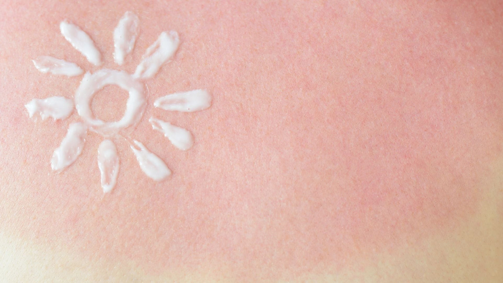 The Sunburn Soothing Secret You Need This Summer