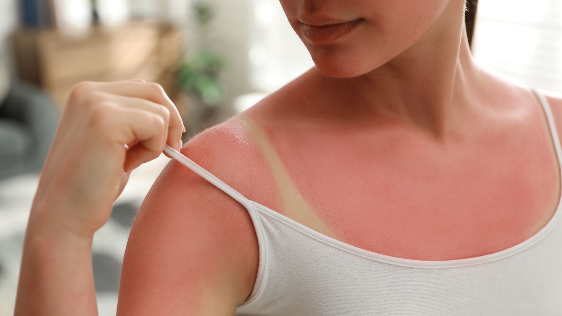 Woman lifts tank top strap to reveal bad sunburn